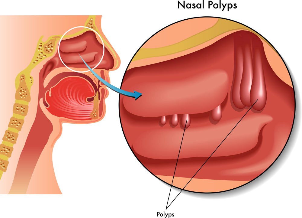 鼻息肉有哪些症状表现