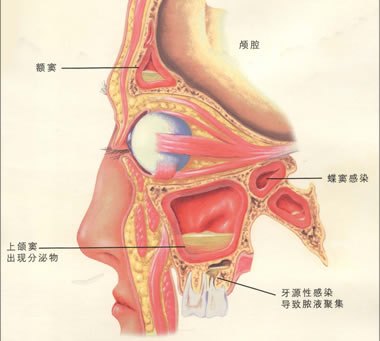 得了鼻炎怎么办