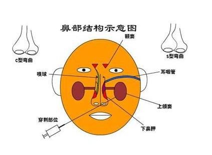 慢性鼻炎的危害有哪些