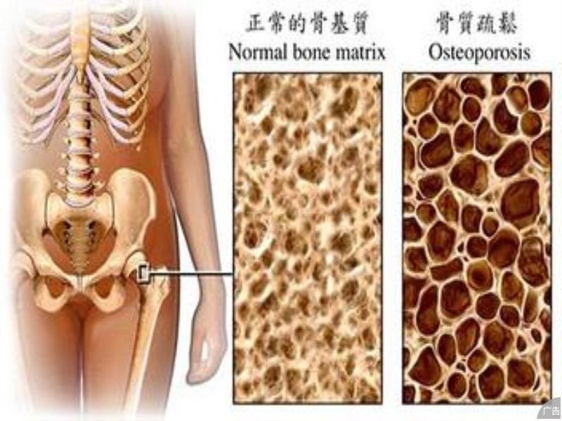 骨质疏松有哪些方法可以治疗