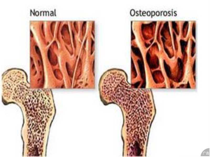 骨质疏松的症状有哪些