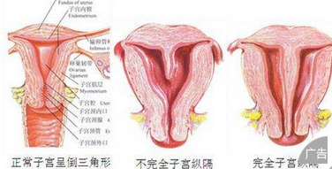 七大子宫问题易引发子宫性不孕