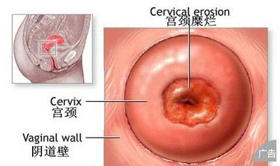 宫颈糜烂的症状有哪些
