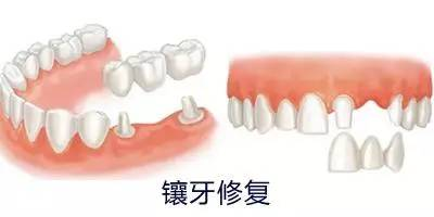 镶牙材料哪种好